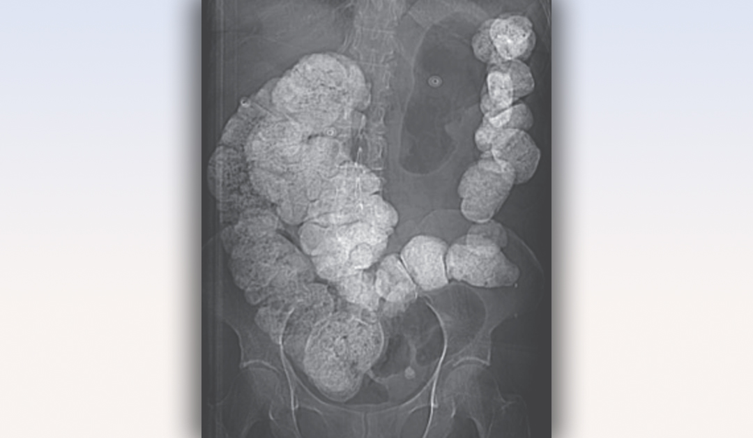 nejm-on-twitter-a-70-yo-woman-with-depression-and-ibs-presented-to