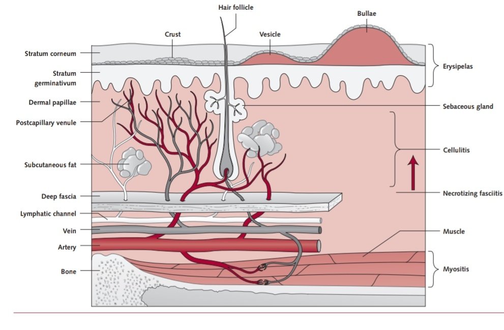 SOMELaguna's tweet photo. Celulitis e Infecciones de tejidos blandos🧫🔬

1️⃣Definiciones
2️⃣Anatomía
3️⃣Fisiopatologia
4️⃣Etiología
5️⃣Diagnóstico
6️⃣Tratamiento antibiótico oral e IV
7️⃣Pronóstico

doi:10.7326/AITC201802060

🔓📃https://t.co/pdXNGW81H8 https://t.co/3OcxV4fqFv