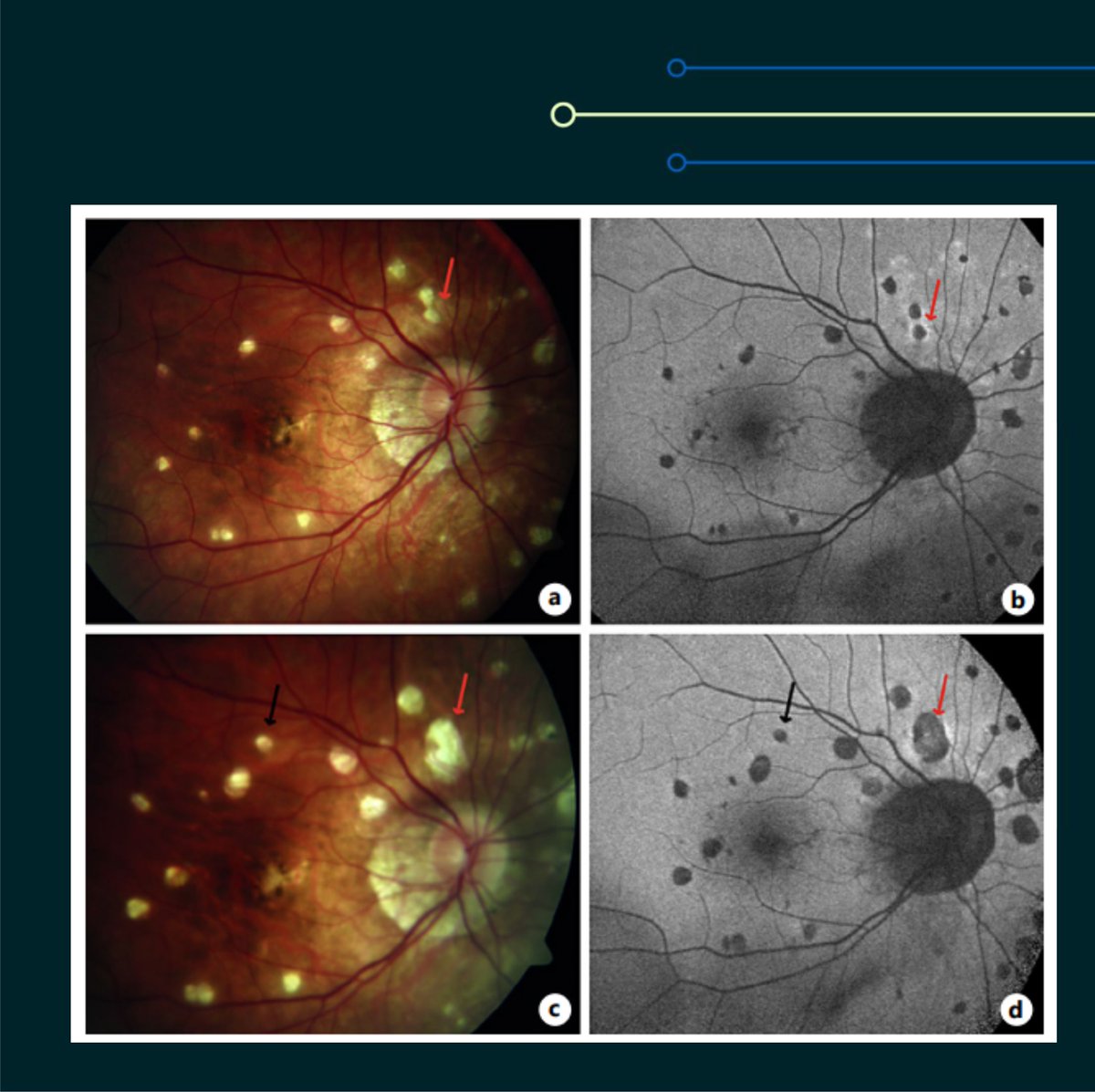 YoungRetina's tweet photo. Assessing relapse risk in multifocal choroiditis and PIC. Editors choice Ophthalmologica. Full article:
https://t.co/0dGMpo4oCk
#choroiditis #choroidopathy #eyeinflammation #ocularinflammation https://t.co/6Id9EkCVaR