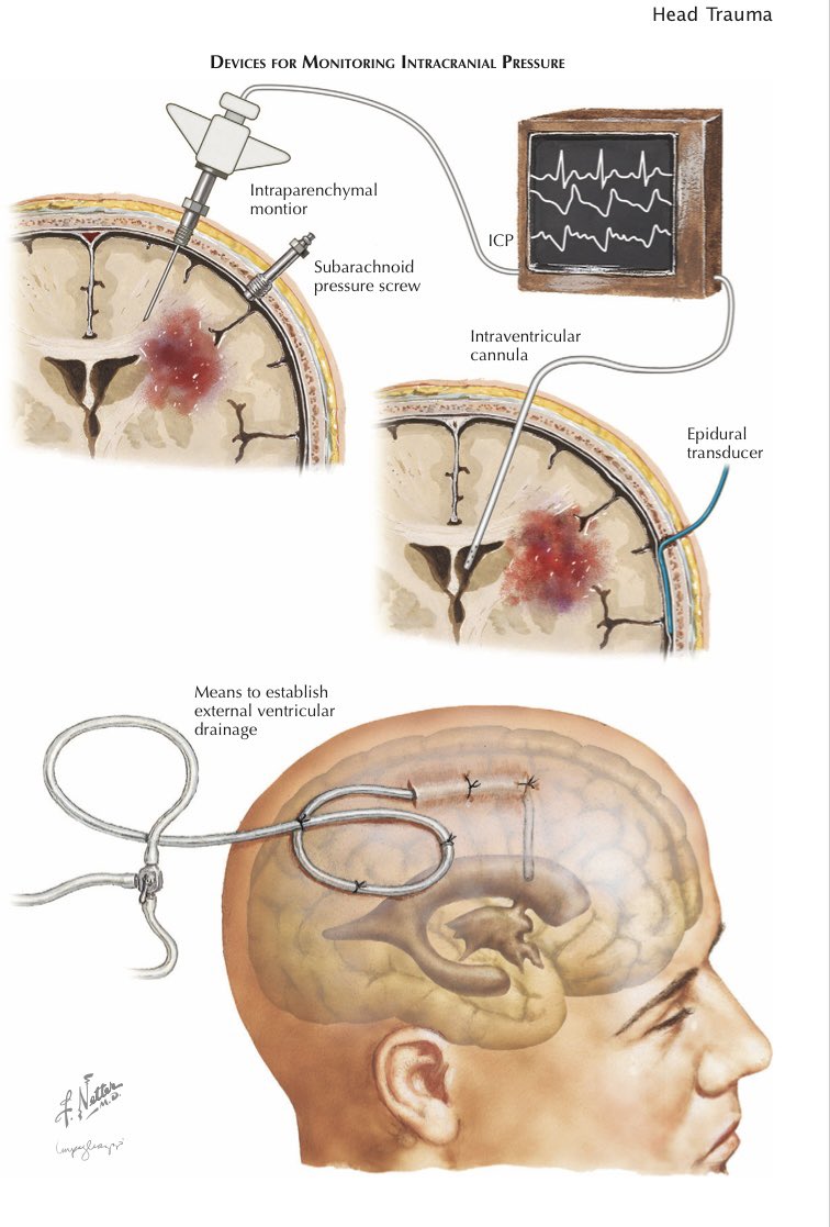 Intracranial pressure primer from netter. Teach us anything you know about ICP and CPP and EVDs.