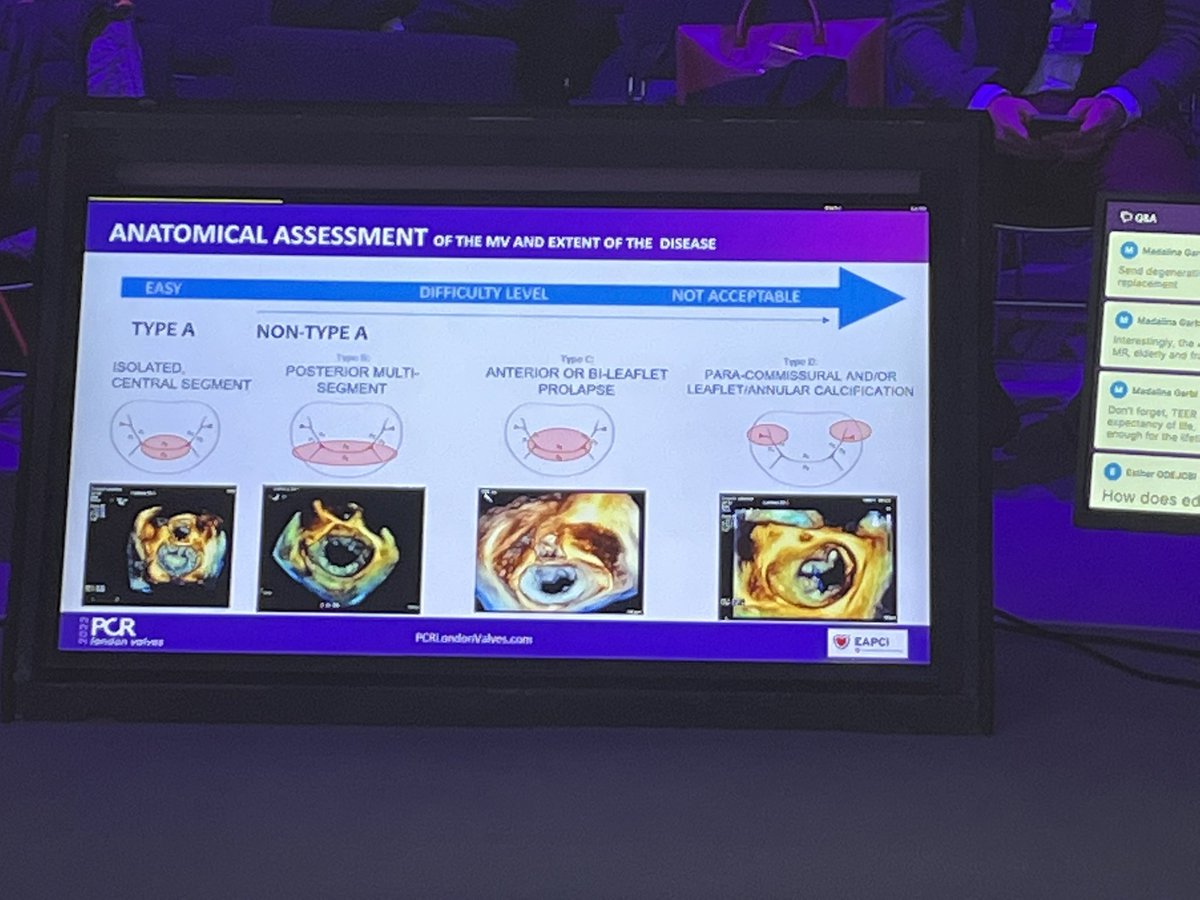 VDelgadoGarcia's tweet photo. #PCRLV today there were mitral and tricuspid tracks excellent cases, presentations and discussions @patmahia @AnnaSannino1985 @dralisonduncan @hahn_rt @FabienPraz @masitges @MadalinaGarbi @didier_tchetche @nicolasdumonte1 https://t.co/zdrrT71vGG