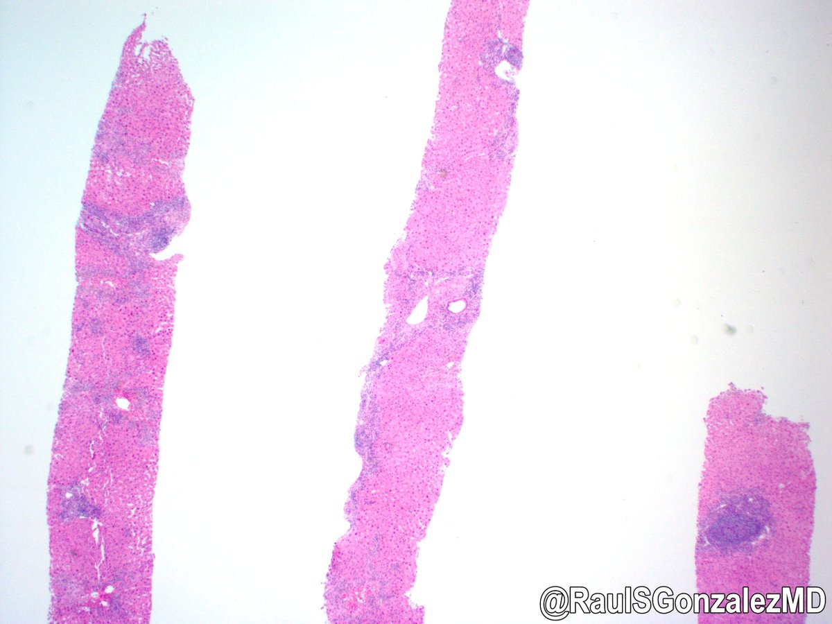 Raul S. Gonzalez, MD on Twitter "Old cases, day 9 plasma cellrich