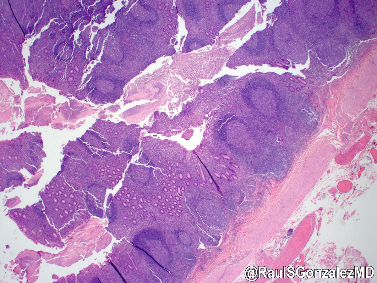 RaulSGonzalezMD's tweet image. Old cases, day 10: adenovirus appendicitis. This was a pediatric case I found in the archives, so I can’t take credit for the eagle eyes required to spot the viral cytopathic effect (smudgy, glassy nuclei). Never knowingly seen a case since. #pathology #gipath #PathTwitter