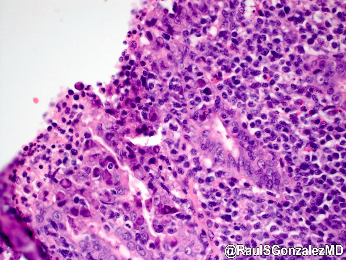 RaulSGonzalezMD's tweet image. Old cases, day 10: adenovirus appendicitis. This was a pediatric case I found in the archives, so I can’t take credit for the eagle eyes required to spot the viral cytopathic effect (smudgy, glassy nuclei). Never knowingly seen a case since. #pathology #gipath #PathTwitter