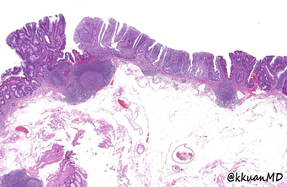 kkuanMD's tweet photo. Curtesy of @Mehdirahimi1354: Tubular adenoma with clear cell change. #pathtwitter #gipath #pathology #pathboards #patheducation @ridin_bk_MD @RSekhri_MD @c_castrodad @yokoda_md @pembeoltulu @TristanRutland7 @ALBoothMD @Dr_Brian_Cox https://t.co/0p3kU4TRsh