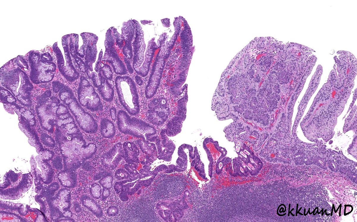 kkuanMD's tweet photo. Curtesy of @Mehdirahimi1354: Tubular adenoma with clear cell change. #pathtwitter #gipath #pathology #pathboards #patheducation @ridin_bk_MD @RSekhri_MD @c_castrodad @yokoda_md @pembeoltulu @TristanRutland7 @ALBoothMD @Dr_Brian_Cox https://t.co/0p3kU4TRsh