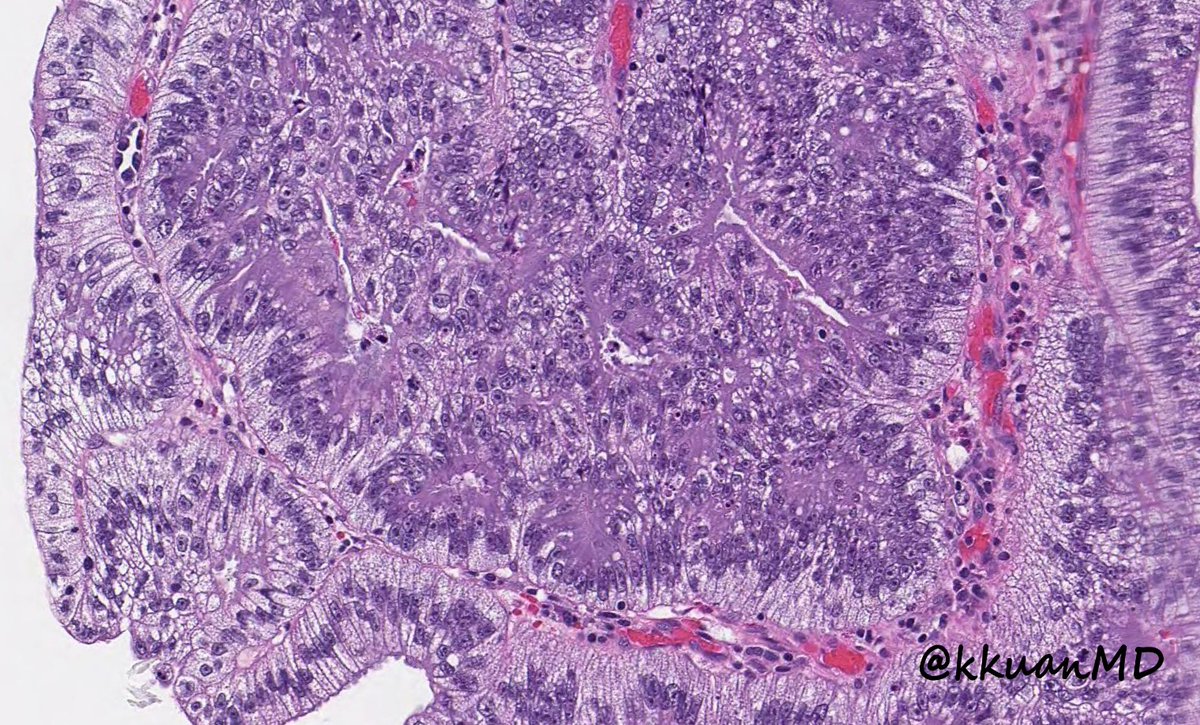 kkuanMD's tweet photo. Curtesy of @Mehdirahimi1354: Tubular adenoma with clear cell change. #pathtwitter #gipath #pathology #pathboards #patheducation @ridin_bk_MD @RSekhri_MD @c_castrodad @yokoda_md @pembeoltulu @TristanRutland7 @ALBoothMD @Dr_Brian_Cox https://t.co/0p3kU4TRsh
