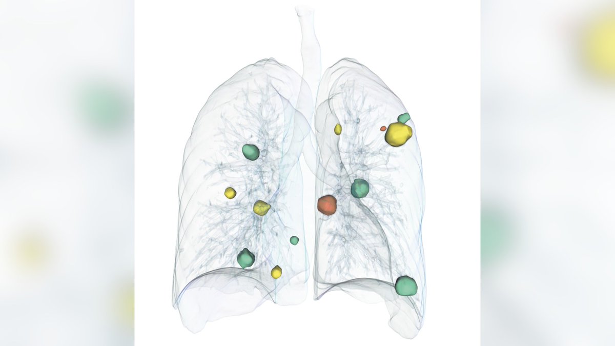 Assessing #tumor #followup #CT takes too much time? #AI can speed up the #clinicalWorkflow. Find out more at #RSNA22, South Hall L3 booth 2205 s.fhg.de/RSNA22
#Radiology #Oncology