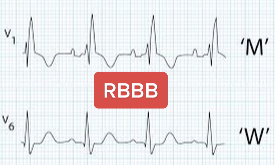 AvrahamCooperMD's tweet photo. A SUPER easy way to remember bundle branch blocks on ECG - 

                v1        v6
               ⬇️       ⬇️
LBBB  =  WiLLiaM 
RBBB  = MaRRoW 

#MedTwitter https://t.co/xVDFEE5Fsy