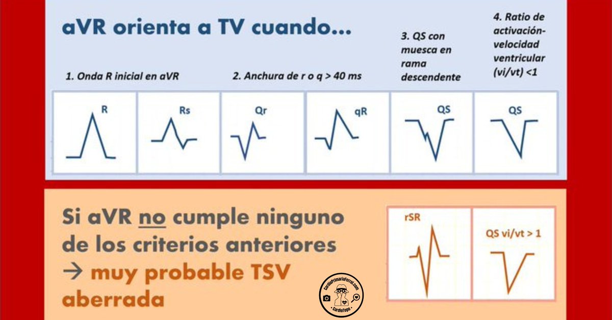 CardioAPFerrol's tweet photo. ¿Repasamos los #CardioTrucos para diferenciar taquicardia ventricular (TV) de taquicardia supraventricular aberrada (TSV aberrada)?

⭐️Algoritmo de Vereckei ➡️aVR
⭐️Signo de Josephson➡️ derivaciones septales
⭐️Signo de Marriott ➡️V1
⭐️Presencia de latidos de captura y fusión https://t.co/nPLUbfWdRl