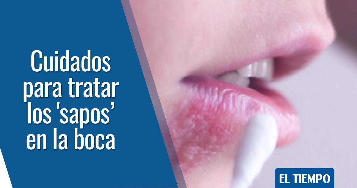 Llagas en la boca: 3 remedios que funcionan