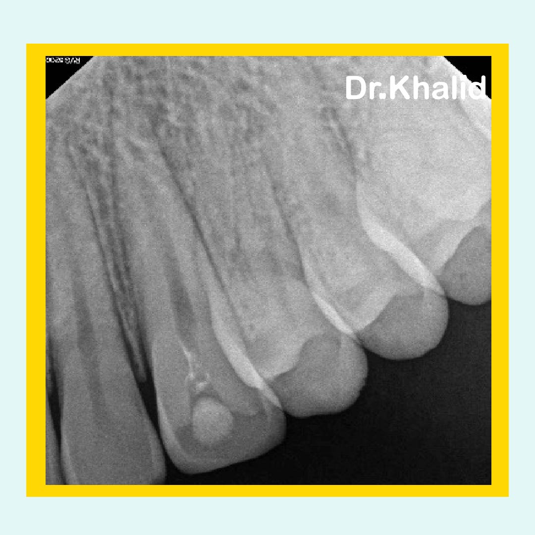 drkamdent's tweet photo. أولى حالاتي في علاج العصب 
خلال سنة خامس 🤓
🦷#23
Dx
Symptomatic irreversible pulpitis 
symptomatic apical periodontitis
Tx 
Non-surgical RCT

#dent #dentist #dentistry https://t.co/xshz18Hjq9