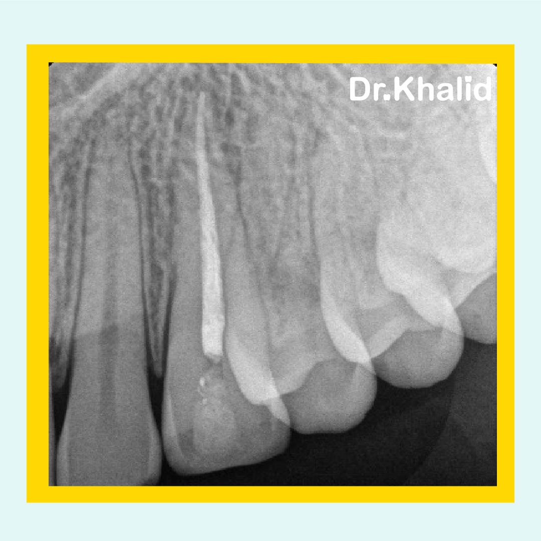 drkamdent's tweet photo. أولى حالاتي في علاج العصب 
خلال سنة خامس 🤓
🦷#23
Dx
Symptomatic irreversible pulpitis 
symptomatic apical periodontitis
Tx 
Non-surgical RCT

#dent #dentist #dentistry https://t.co/xshz18Hjq9