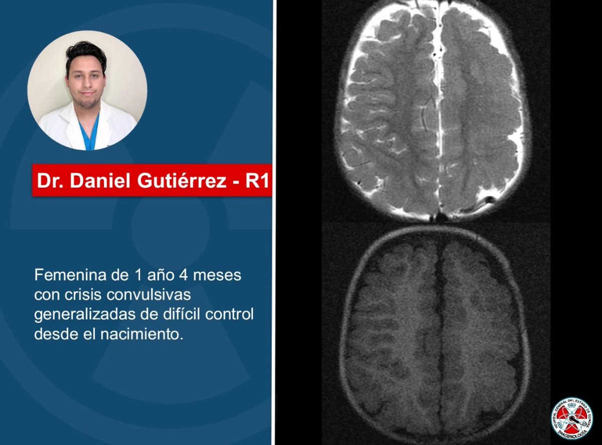 Se presentan imágenes por resonancia magnética de nuestro caso semanal. ¿Cuál es tu diagnóstico?
#Radiology #radres 👁️☢️