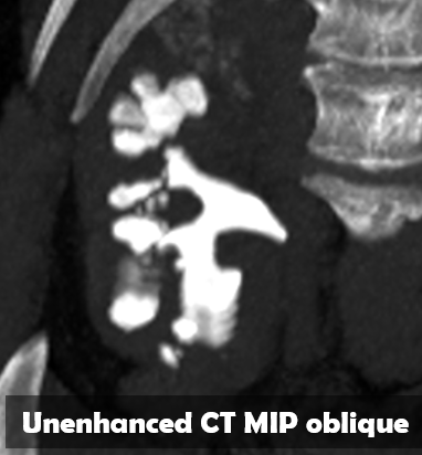 69yo woman. History of leukemia. Worsening of the general state, CKD and inflammatory syndrome. PET : large coralliform stone. MRI : unilateral chronic obstruction, pyonephrosis, normal left kidney. Proteus mirabilis.
#greatradiologyresidents #GUimaging