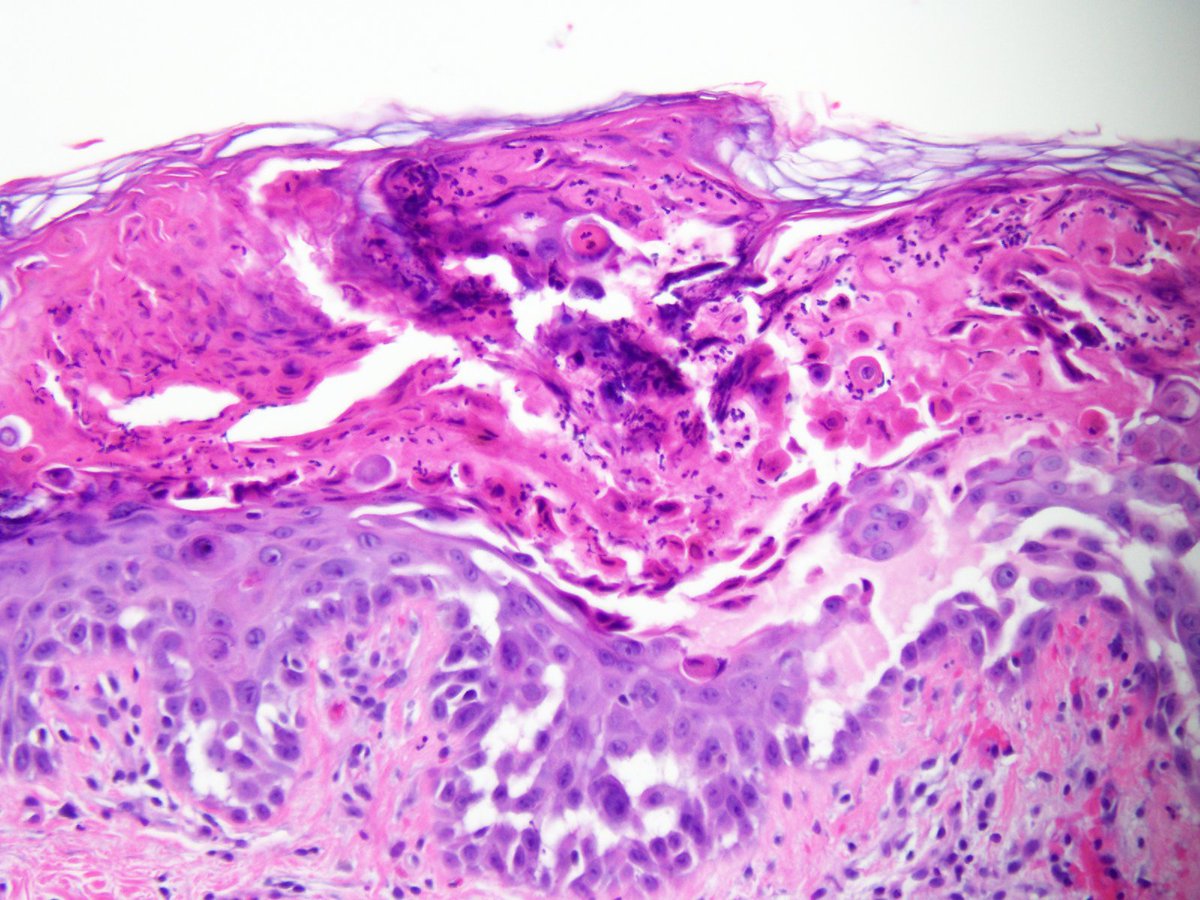 LoyolaDermPath's tweet photo. A 62-year-old female presented with itchy rash on her back. A biopsy was done. What are the histologic findings and tell us your diagnosis? https://t.co/9KgvPuxlab