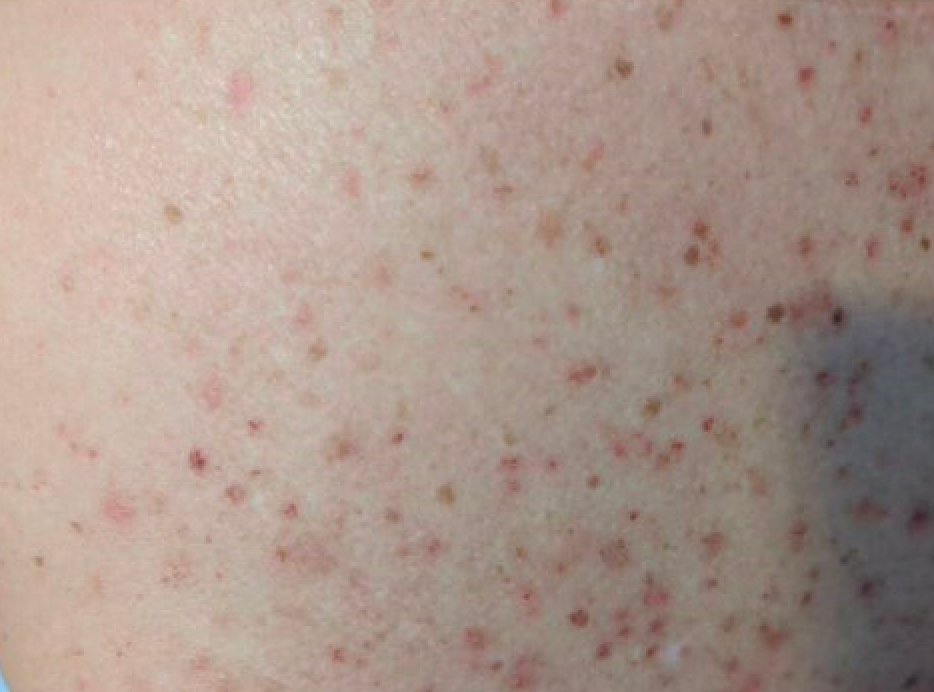 A 62-year-old female presented with itchy rash on her back. A biopsy was done. What are the histologic findings and tell us your diagnosis?