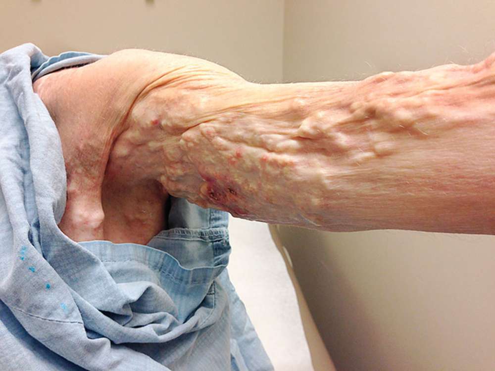 BrownJHM's tweet photo. A 50-year-old woman with dermatomyositis presented with progressive, diffuse subcutaneous nodules on the arms and legs. What is the likely diagnosis? #medtwitter https://t.co/GUBudFeFiK