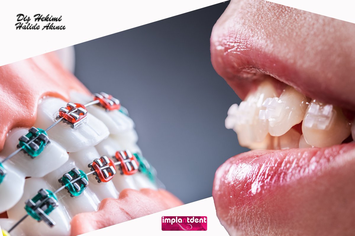 Diş çarpıklığı kader değildir. Güzel gülüşler sizin de hakkınız.

Bilgi ve Randevu: 0212 556 45 30
#ortodonti #implantüstü #estetikgülüş #implant #botoks #dudakdolgusu #şeffafplak #nasolabial #altyüzdolgusu #estetikprotez #dişteli #çocukdiş #dişbeyazlatma #pedodonti #implantdent