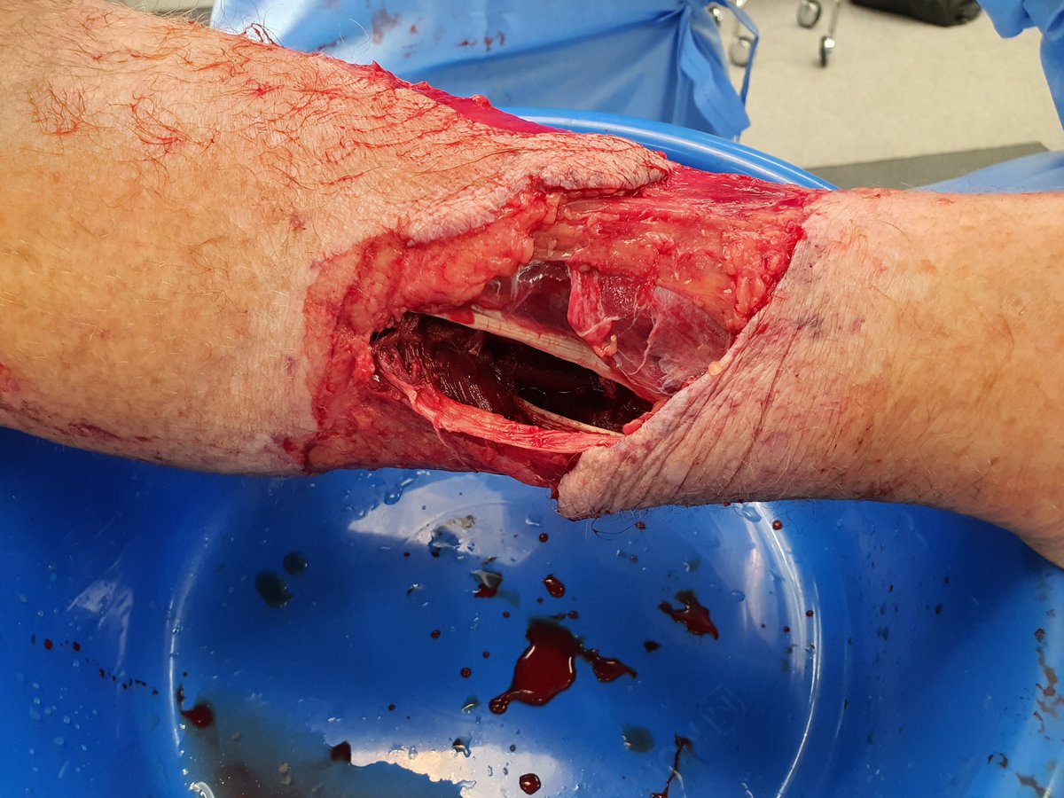WA_trauma's tweet photo. @PolyNovoLTD @kirsten_bee @karimbrohi @MartinSchreib10 
have been very impressed with dermal replacement using BTM biodegradable before skin graft.  Seems quite  robust from infection. Able to discharge early and manage as outpatient till SSG. No conflict of interest to declare. https://t.co/2SUI5Ca5I8
