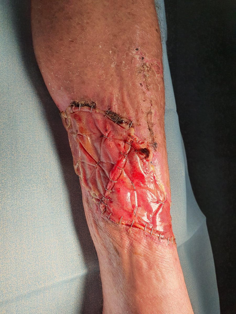 WA_trauma's tweet photo. @PolyNovoLTD @kirsten_bee @karimbrohi @MartinSchreib10 
have been very impressed with dermal replacement using BTM biodegradable before skin graft.  Seems quite  robust from infection. Able to discharge early and manage as outpatient till SSG. No conflict of interest to declare. https://t.co/2SUI5Ca5I8