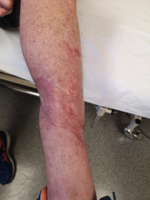 WA_trauma's tweet photo. @PolyNovoLTD @kirsten_bee @karimbrohi @MartinSchreib10 
have been very impressed with dermal replacement using BTM biodegradable before skin graft.  Seems quite  robust from infection. Able to discharge early and manage as outpatient till SSG. No conflict of interest to declare. https://t.co/2SUI5Ca5I8