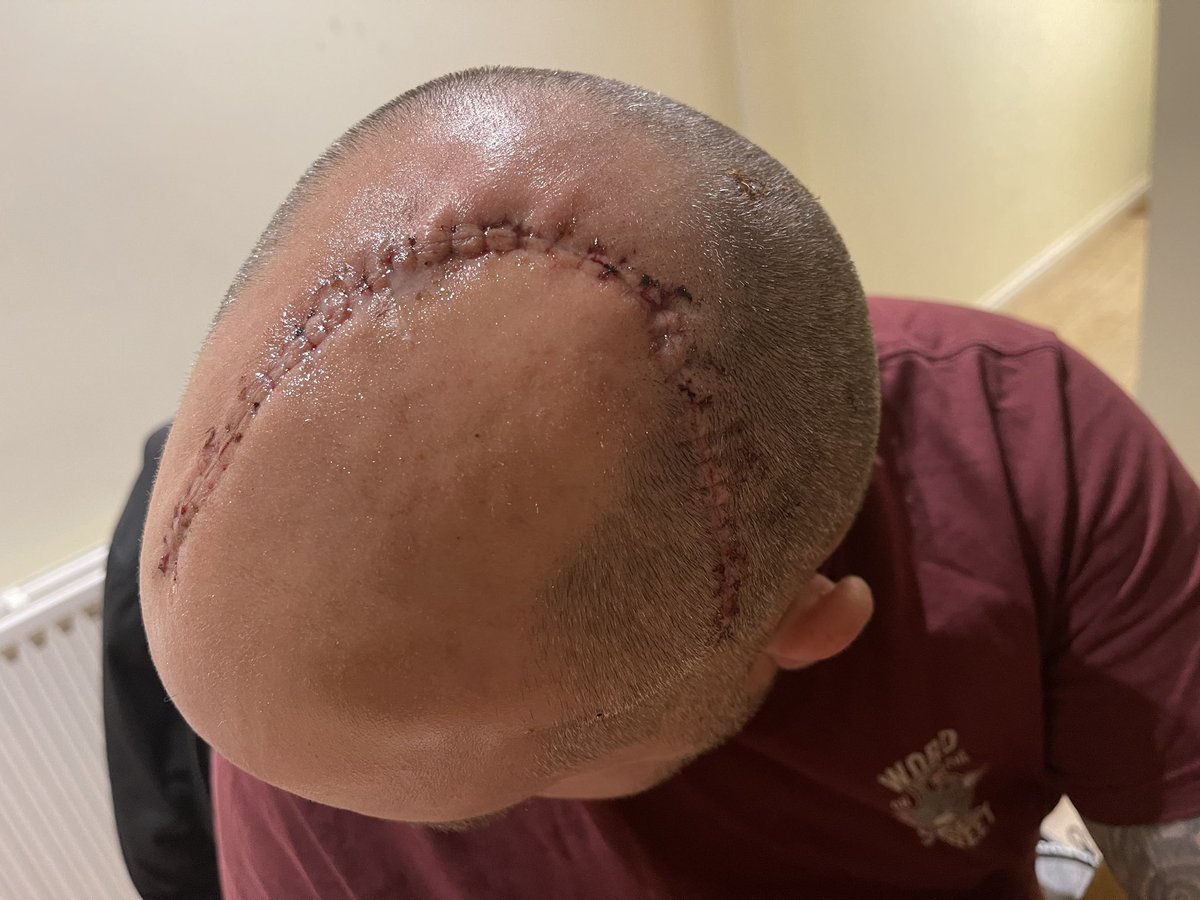 It’s 4.5 years since my last, but unfortunately I had to have more surgery. The radiotherapy didn’t work and the tumour started growing again.
Last surgery I started streaming as a way to keep in contact with the outside world, maybe I will start again.
#BrainTumour #Streaming