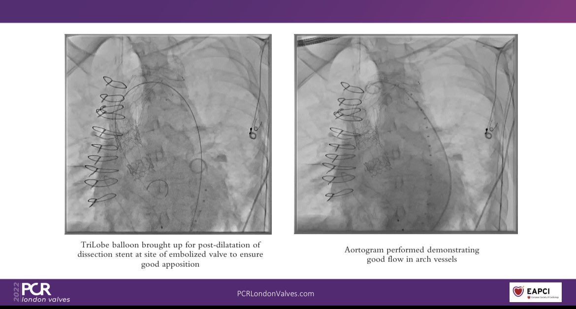 Konstantinos Stathogiannis (@dr_ksav) on Twitter photo #PCRLV #ViV #TAVR Interesting session with great cases and learning points! <a href="/drrahulpsharma/">Rahul Sharma</a> #PCRLV #ViV #TAVR Interesting session with great cases and learning points! <a href="/drrahulpsharma/">Rahul Sharma</a>