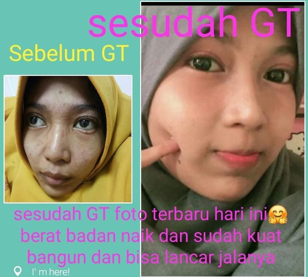 aries_setiadi32's tweet photo. Putri Ibu Rohana Dari Bekasi 27 hari Di Rawat di RS karna Penyakit Lambung Akut , 2 bln Yang lalu ketemu Bunda Coba konsumsi GT 3 hari sudah bisa Nafsu makan dan BAB lancar , buang air terus Menerus sebagai pembuangan Racun dlm Tubuh nya

Minat hub
👇👇👇
https://t.co/6kYuFXvabZ https://t.co/heHDgdRRck