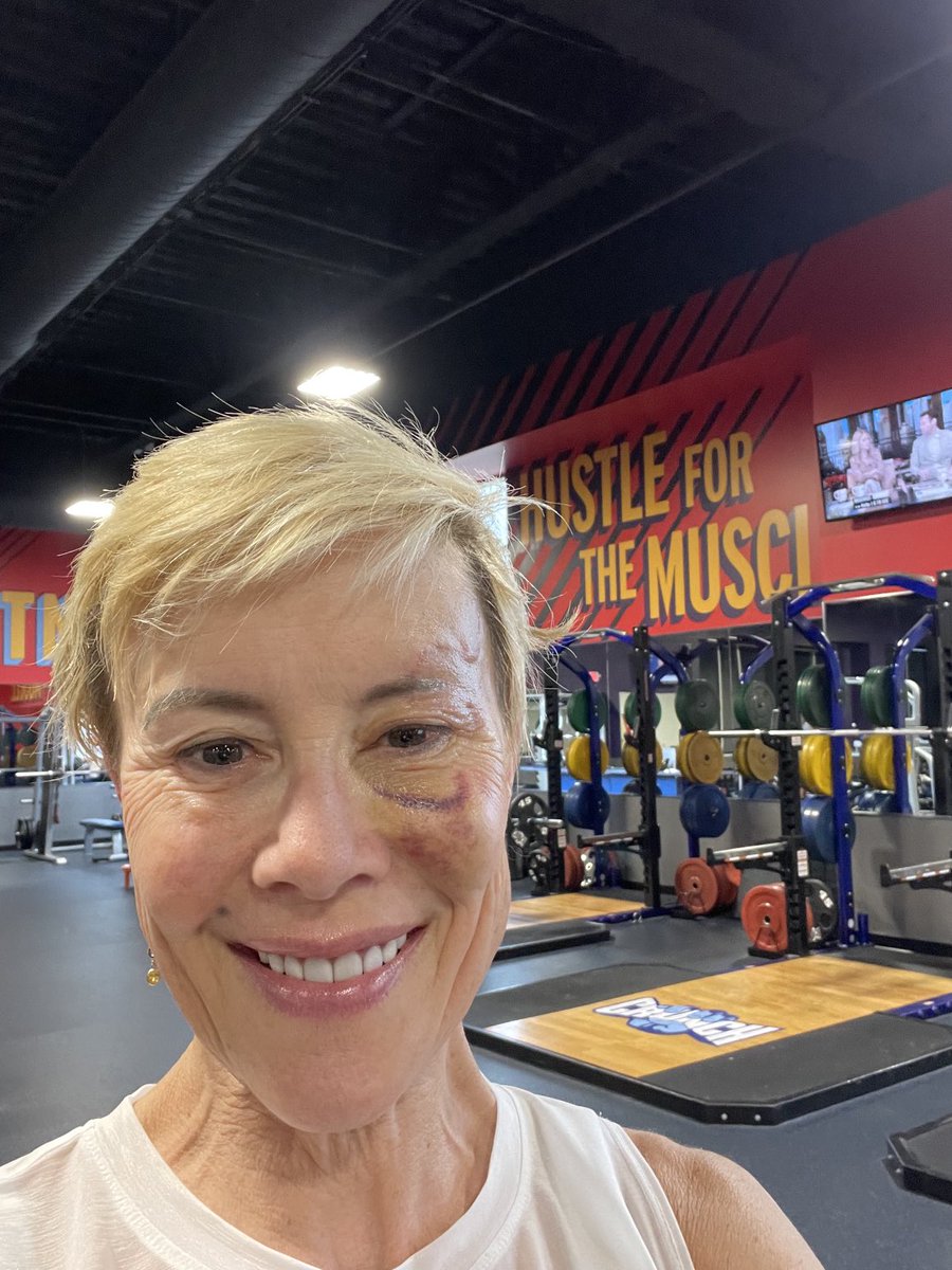 PaulaMaier3's tweet photo. Hard to come to the public gym with my face like this but hey!, Iโm here to reduce stress, fight cancer & improve my body- not win a beauty contest!
#wtf #gymmotivation #skincancer #basilcellcancer #showup #destress #fightcancer #livestrong #hustleforthatmuscle #womenshealth https://t.co/DtFaDRtHTs