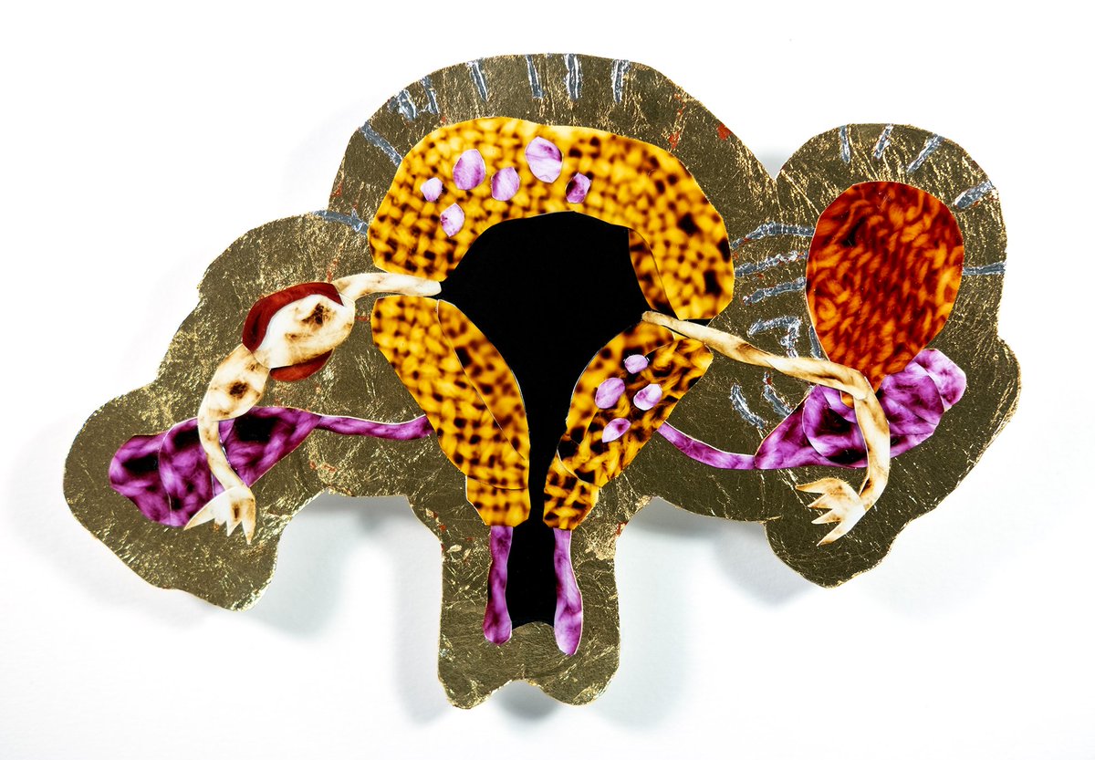 Collage of a yellow uterus with pink ovaries and vagina, endometriosis and adenomyosis lesions, and an orange ovarian cyst. The collage is on a gold metallic background with silver stripes. - Maria (she/her, white, 28, in US) #endometriosis #ovariancyst