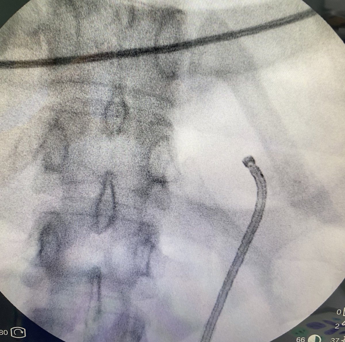 Stone mass in upper calyx (~3cm, 800UH). Opted for FURS after discussion with the patient.  Result after 1 hour of procedure with 25W device.  Second procedure plan for fragment evaluation.  Moment I miss the high power device for a good dusting …