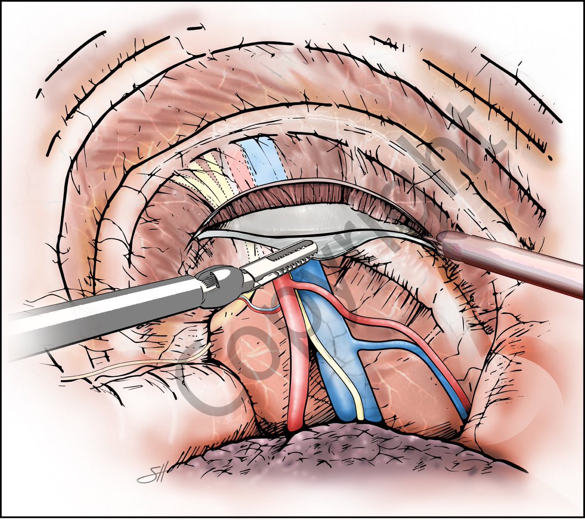 Robotic rib resection for thoracic outlet syndrome <a href="/BMBurtMD/">Bryan M. Burt</a> <a href="/BCM_Thoracic/">David J. Sugarbaker Division of Thoracic Surgery</a> <a href="/BCM_Surgery/">BCM_Surgery</a>