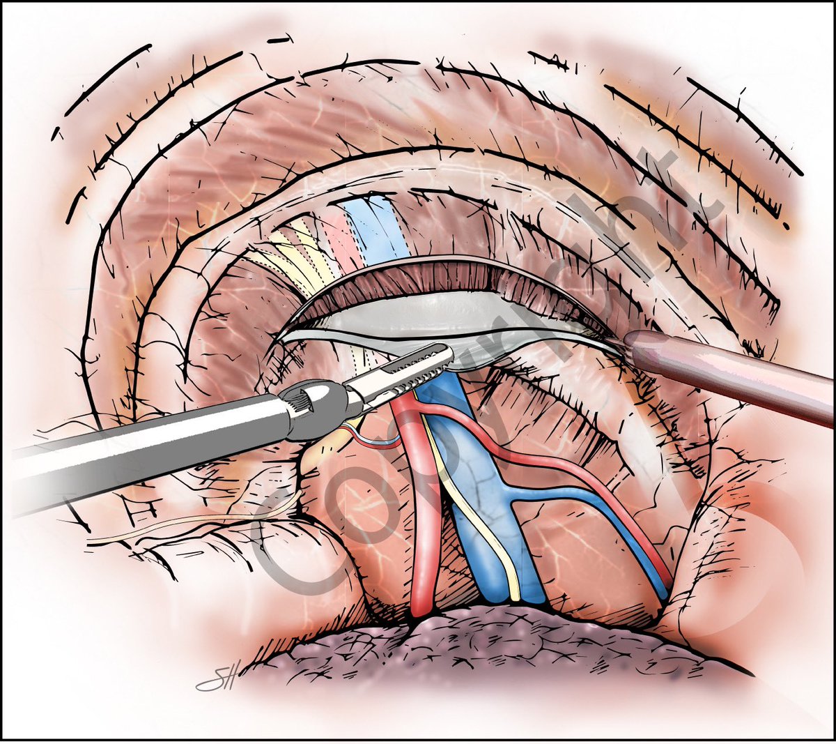 Robotic rib resection for thoracic outlet syndrome @BMBurtMD @BCM_Thoracic @BCM_Surgery