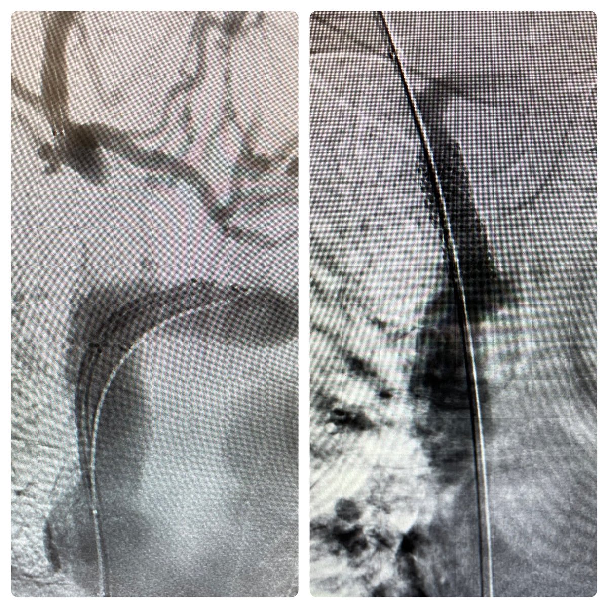 Hot take: there are no uncrossable venous occlusions.

Don’t condemn patients to a lifetime of femoral tunneled catheters or debilitating face and arm swelling without referring first to centers with appropriate equipment and experience to get these vessels open. #irad <a href="/LLUHealth/">Loma Linda U. Health</a>