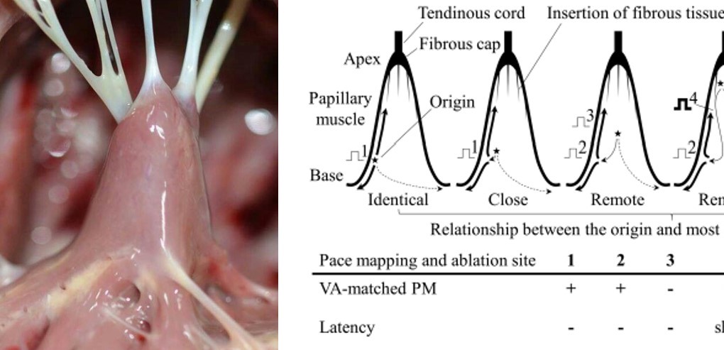 Yuksek Ihtisas Arrhythmia- Ankara City Hospital (@ach_epteam) on Twitter photo It s harder to obtain(intentionally?) good CF in apical vs base PM <a href="/drgarez/">Murat Kerkutluoglu</a> <a href="/simsekersinc/">Ersin Çağrı Şimşek</a> <a href="/Drersoy84/">İbrahim Ersoy</a> <a href="/GokhanCeyhun1/">Gokhan Ceyhun</a> <a href="/drsihohidayet/">ŞIHO HİDAYET</a> <a href="/MeltemAltnsoy/">ScarelatedVT</a> <a href="/Drmuammerkardio/">Muammer Karakayalı</a> <a href="/aliugursoysal/">Ali Uğur Soysal</a> <a href="/Mkara_EP/">Mkara</a> <a href="/ElifhandeMD/">Elif Hande Özcan Çetin</a> <a href="/DuyguKocyigitMD/">Duygu Kocyigit Burunkaya</a> <a href="/prof_serkan_cay/">Prof Dr Serkan Cay</a> <a href="/AhmetKorkmaz07A/">Ahmet</a> <a href="/DursunAras2/">Dursun Aras, Professor</a> <a href="/topaloglu_prof/">Serkan Topaloglu, MD</a> It s harder to obtain(intentionally?) good CF in apical vs base PM <a href="/drgarez/">Murat Kerkutluoglu</a> <a href="/simsekersinc/">Ersin Çağrı Şimşek</a> <a href="/Drersoy84/">İbrahim Ersoy</a> <a href="/GokhanCeyhun1/">Gokhan Ceyhun</a> <a href="/drsihohidayet/">ŞIHO HİDAYET</a> <a href="/MeltemAltnsoy/">ScarelatedVT</a> <a href="/Drmuammerkardio/">Muammer Karakayalı</a> <a href="/aliugursoysal/">Ali Uğur Soysal</a> <a href="/Mkara_EP/">Mkara</a> <a href="/ElifhandeMD/">Elif Hande Özcan Çetin</a> <a href="/DuyguKocyigitMD/">Duygu Kocyigit Burunkaya</a> <a href="/prof_serkan_cay/">Prof Dr Serkan Cay</a> <a href="/AhmetKorkmaz07A/">Ahmet</a> <a href="/DursunAras2/">Dursun Aras, Professor</a> <a href="/topaloglu_prof/">Serkan Topaloglu, MD</a>