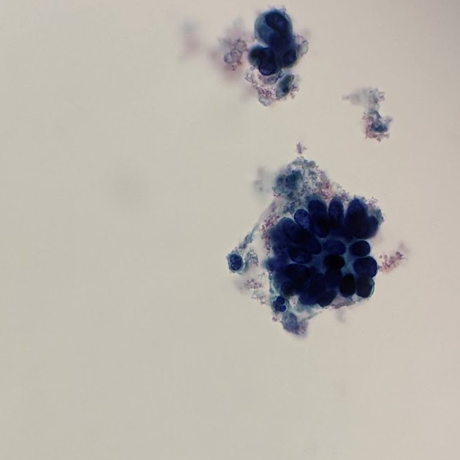 smcnair0328's tweet photo. It isn't every day that you put a pap slide down and immediately say "at least AIS". Textbook feathering!!! 
@Sara_Jiang @JS_Cytotech @TotalCytopath @EmelineAvikiMD @EHJPathDiva @JinXueting @CytoMermaid @MLisaZhang @MichelleReidMD @sza_jhcyto 
#cytopath #pathtwitter https://t.co/n0wYDnC3GK