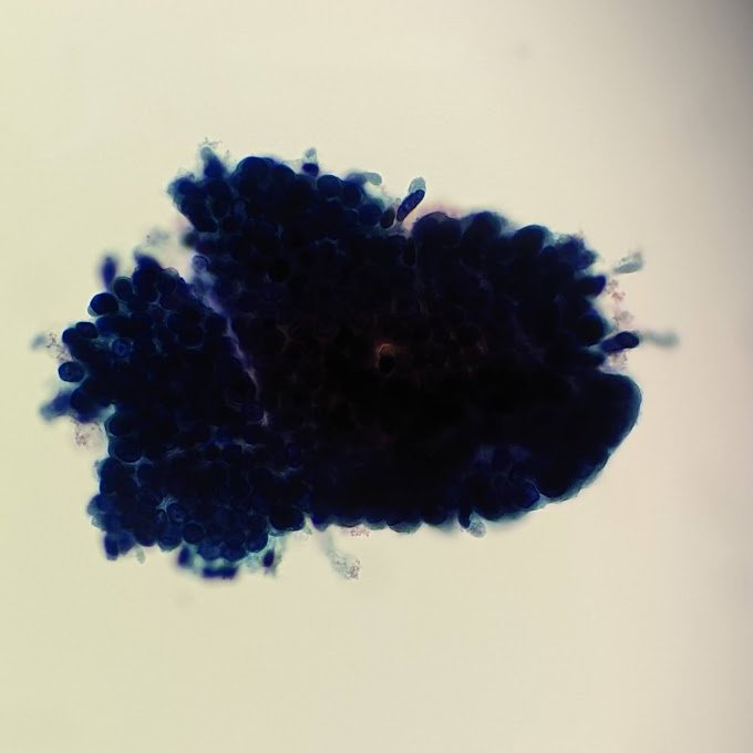 Sean McNair (@smcnair0328) on Twitter photo It isn't every day that you put a pap slide down and immediately say "at least AIS". Textbook feathering!!!
<a href="/Sara_Jiang/">Xiaoyin "Sara" Jiang, MD (She/Her)</a> <a href="/JS_Cytotech/">Jillian</a> <a href="/TotalCytopath/">Philippe Stephenson, MD</a> <a href="/EmelineAvikiMD/">Emeline Aviki, MD, MBA</a> <a href="/EHJPathDiva/">Evita Henderson Jackson MD</a> <a href="/JinXueting/">Xueting "Tina" Jin</a> <a href="/CytoMermaid/">Taryn Waraksa-Deutsch, DHSc, SCT(ASCP), CMIAC</a> <a href="/MLisaZhang/">M. Lisa Zhang, MD</a> <a href="/MichelleReidMD/">Michelle Reid MD</a> <a href="/sza_jhcyto/">Syed Z. Ali</a>
#cytopath #pathtwitter It isn't every day that you put a pap slide down and immediately say "at least AIS". Textbook feathering!!!
<a href="/Sara_Jiang/">Xiaoyin "Sara" Jiang, MD (She/Her)</a> <a href="/JS_Cytotech/">Jillian</a> <a href="/TotalCytopath/">Philippe Stephenson, MD</a> <a href="/EmelineAvikiMD/">Emeline Aviki, MD, MBA</a> <a href="/EHJPathDiva/">Evita Henderson Jackson MD</a> <a href="/JinXueting/">Xueting "Tina" Jin</a> <a href="/CytoMermaid/">Taryn Waraksa-Deutsch, DHSc, SCT(ASCP), CMIAC</a> <a href="/MLisaZhang/">M. Lisa Zhang, MD</a> <a href="/MichelleReidMD/">Michelle Reid MD</a> <a href="/sza_jhcyto/">Syed Z. Ali</a>
#cytopath #pathtwitter