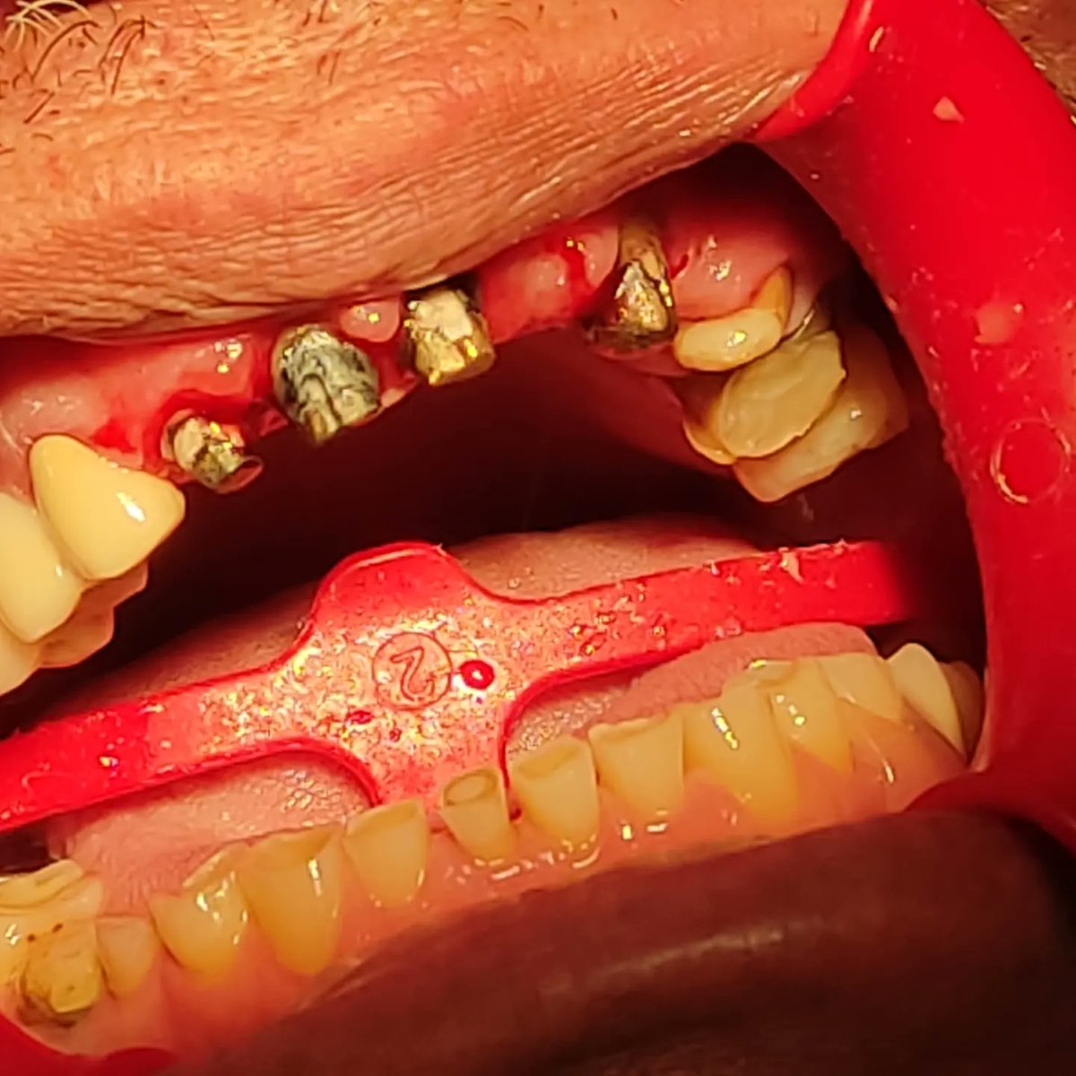 drluisurra's tweet photo. Recuerden, SIEMPRE debemos hacer prueba de metal o de núcleo en cada una de las #protesisdentales que vayamos a cementar.
#dentista #odontologia #dientesblancos #dentistry #stunningsmile #Irapuato #guanajuato #dentist #rootcanal #protesisdental #bichectomia #esteticadental https://t.co/FuLCDQKVuE