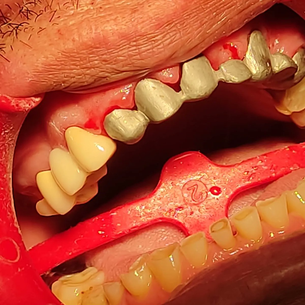 drluisurra's tweet photo. Recuerden, SIEMPRE debemos hacer prueba de metal o de núcleo en cada una de las #protesisdentales que vayamos a cementar.
#dentista #odontologia #dientesblancos #dentistry #stunningsmile #Irapuato #guanajuato #dentist #rootcanal #protesisdental #bichectomia #esteticadental https://t.co/FuLCDQKVuE