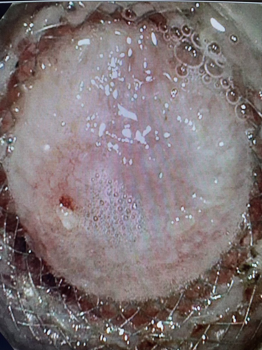 Now that is what I call resolved pancreatic necrosis! #gitwitter #surgery ⁦<a href="/NEndoscopy/">Prof John Leeds</a>⁩ ⁦<a href="/neilRsharmaMD/">Neil Sharma, M.D. FASGE, FACG, AGAF</a>⁩ ⁦<a href="/EUSandEndoscopy/">Scot Michael Lewey</a>⁩