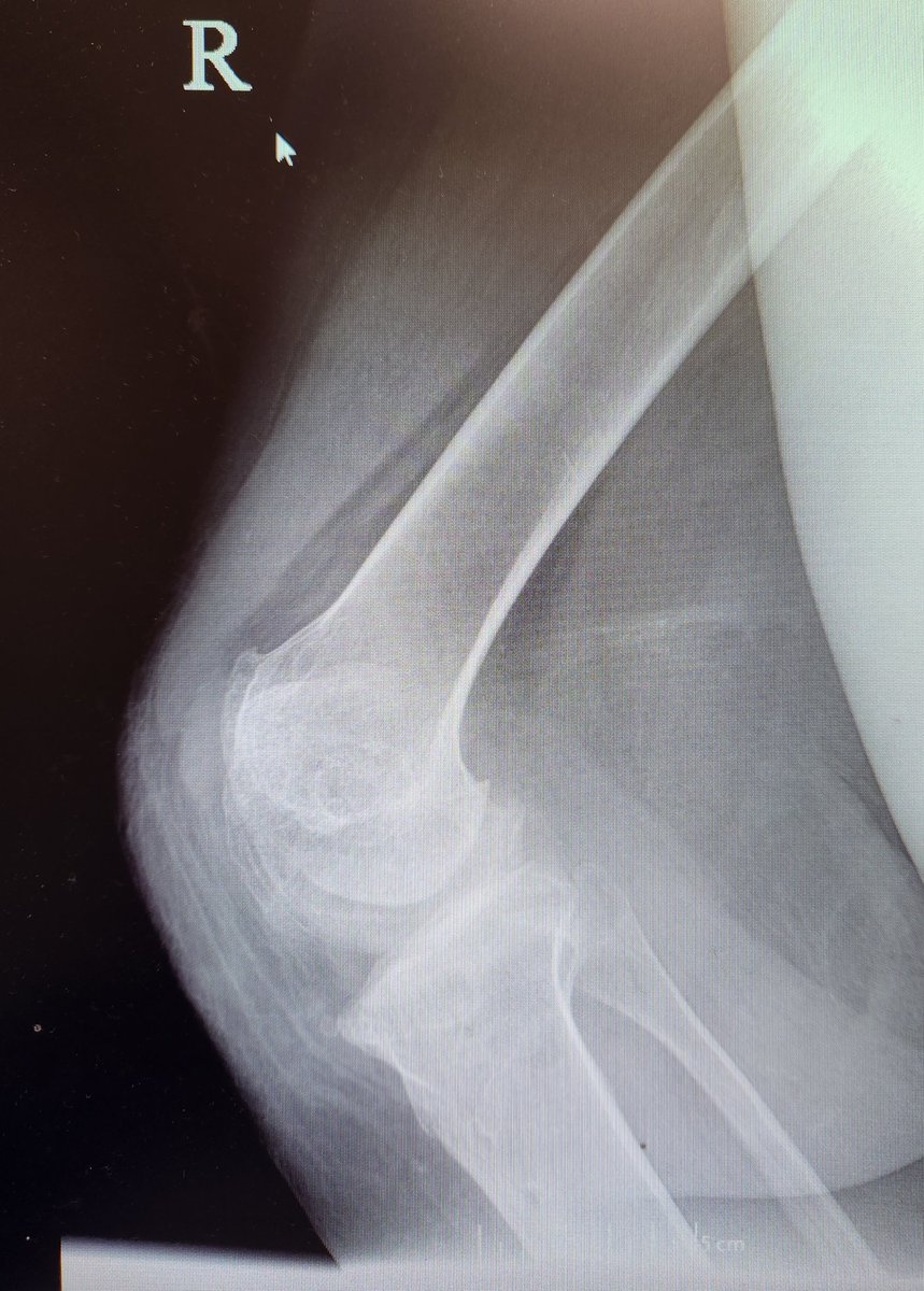 19 yo F h/o mvc with multi-lig knee and CVA. Failed lig recon and now with this. Knee doesn't support mobility. No MCL on exam. What options for reconstruction?

<a href="/ACR_MD/">Anna Cohen-Rosenblum</a> <a href="/CenterRotation/">Brock Howell MD, FAAOS</a> <a href="/MayoHipandKnee/">Mayo Clinic Hip and Knee Reconstruction Fellowship</a> <a href="/EdinburghKnee/">Chloe EH Scott</a> <a href="/JArthroplasty/">The Journal of Arthroplasty</a> <a href="/BrianChalmersMD/">Brian Chalmers</a> <a href="/NaanDerthaal/">Naan Derthaal, DO, FAAOS</a> <a href="/kneedoclond/">Knee Surg in London</a>