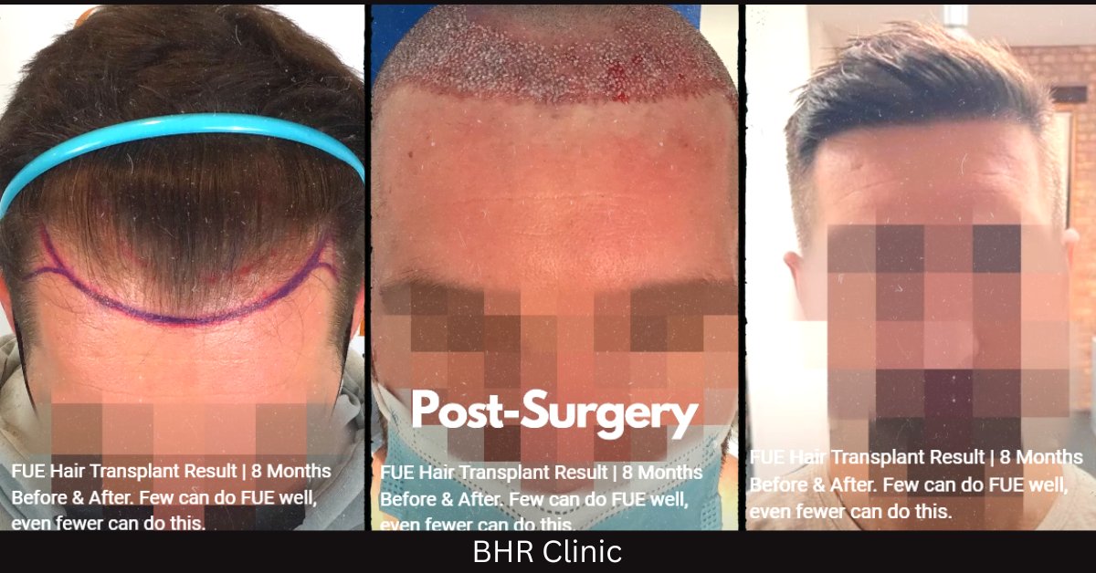 BHR Clinic (Bisanga Hair Restoration) (@BHRClinic) / Twitter BHR Clinic (Bisanga Hair Restoration) (@BHRClinic) / Twitter