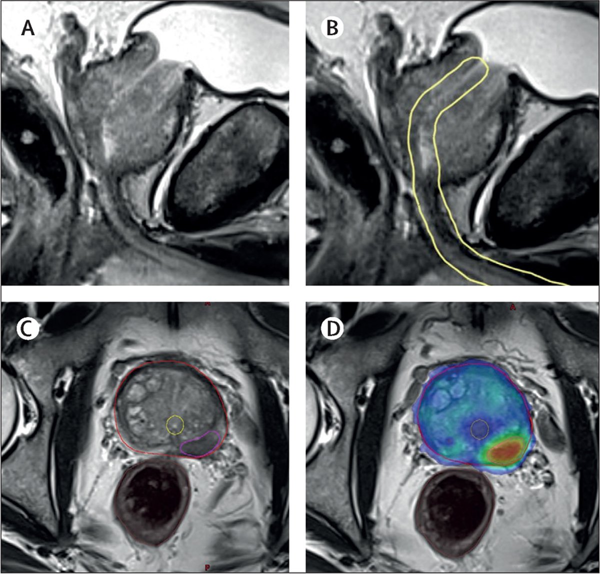 Prof Jarad Martin (@docjarad) on Twitter photo Our review article in the latest <a href="/TheLancetOncol/">The Lancet Oncology</a> on 'Mechanisms, mitigation, and management of urinary
toxicity from prostate #radiotherapy'. Now that GI issues are better controlled, this should be a key #survivorship focus. Let me know what you think. authors.elsevier.com/a/1g9y55EIIgI0⦠Our review article in the latest <a href="/TheLancetOncol/">The Lancet Oncology</a> on 'Mechanisms, mitigation, and management of urinary
toxicity from prostate #radiotherapy'. Now that GI issues are better controlled, this should be a key #survivorship focus. Let me know what you think. authors.elsevier.com/a/1g9y55EIIgI0ā¦