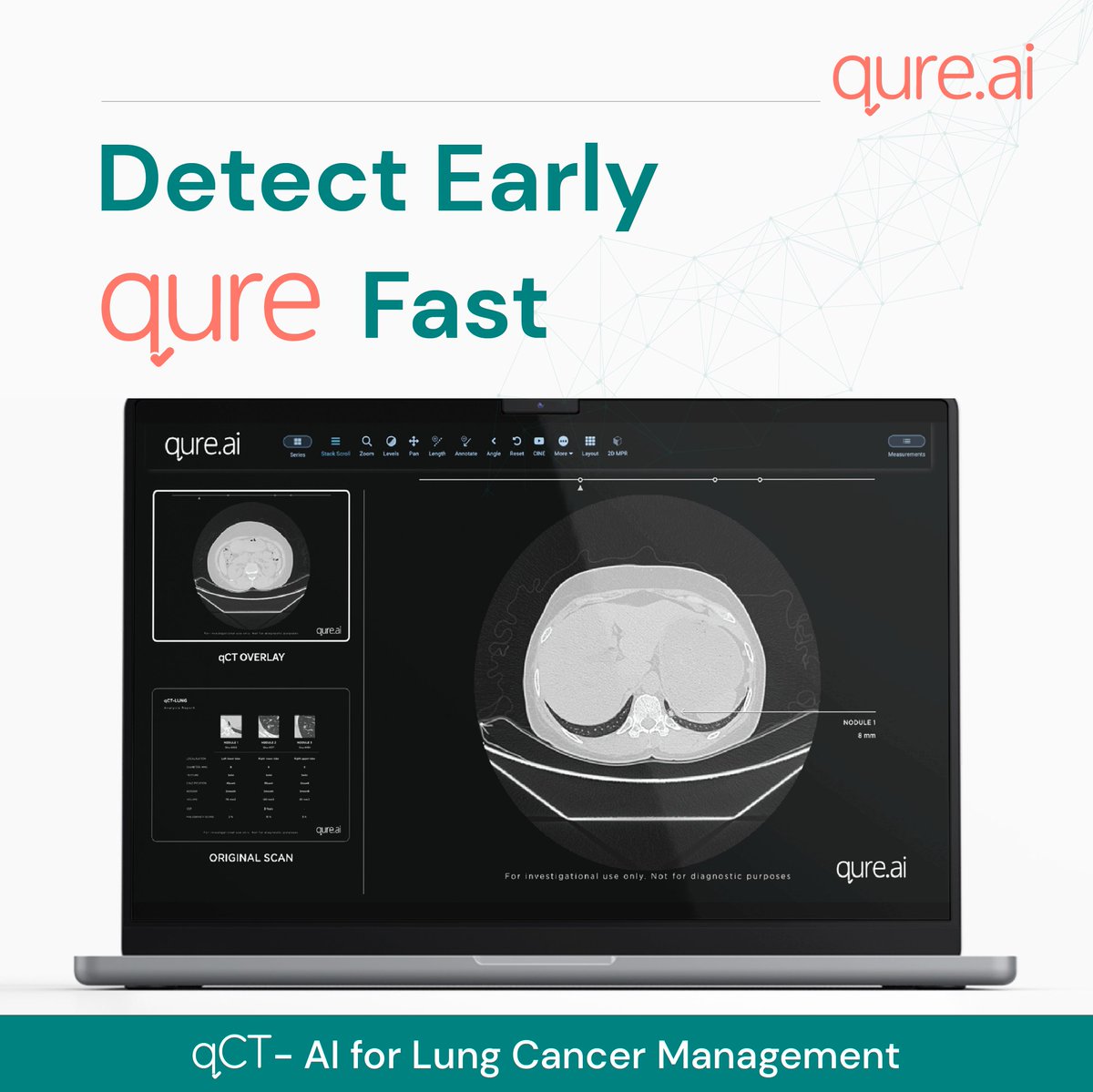 qure_ai's tweet photo. #DetectEarlyQureFast
Here is Qure_ai's qCT, an AI enabled Chest CT solution enabling #earlydetection, a highlight 🧵
✅Detects lung nodules with 95% sensitivity
✅Less than 1 false +ve per scan
✅Measures volumetry, characteristics & malignancy risk score
✅Reports in <1 minute https://t.co/aGrwLg4szN