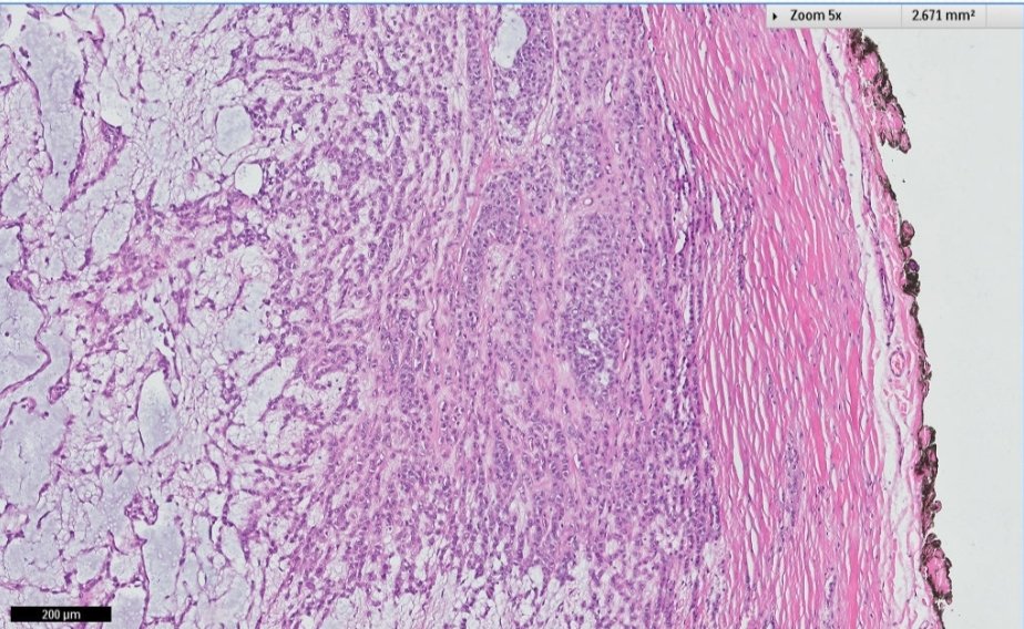 Rafat_abushakra's tweet photo. A 15 year old boy presented with a 3.0 cm well circumscribed painless left inguinal mass. Surgical excision was performed. Cut surface was whitish myxoid with small cysts.
What is your opinion?
#BSTpath
#Pathology
#Pathtwitter
#Pathresidents https://t.co/nllAI8Xn1S