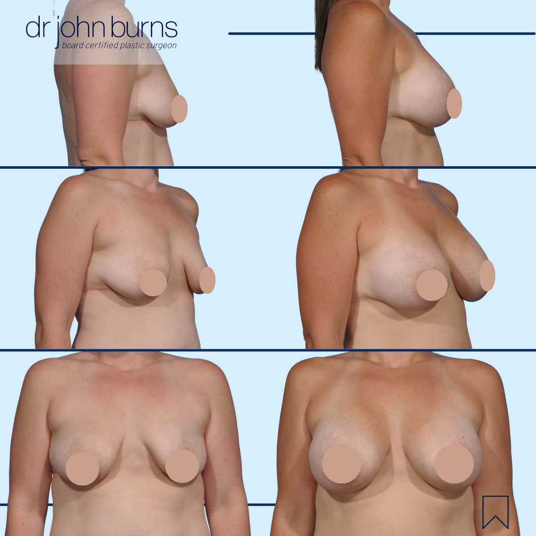 drjohnburns's tweet photo. Mommy #breastaug: This patient wanted more volume, roundness, and upper pole fill after pregnancy. She did NOT want a #breastlift. In cases where a breast lift is sometimes warranted, I'll use a #dualplane technique to create better positioning and alignment of the implants. https://t.co/XFYxVisyIv
