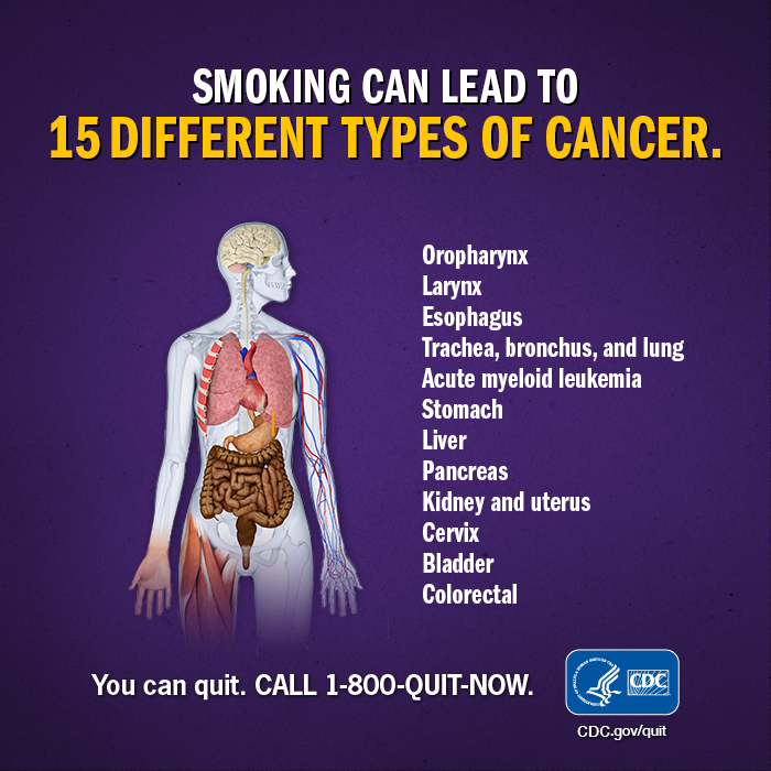 JCIowaPH's tweet photo. It's cancer awareness month. Tell your loved one there is free help to stop smoking and support them while they quit. 1-800-QUIT-NOW or https://t.co/TP7nblhXK6. #Quit4Good #youCANquit https://t.co/vffsf7QmhS