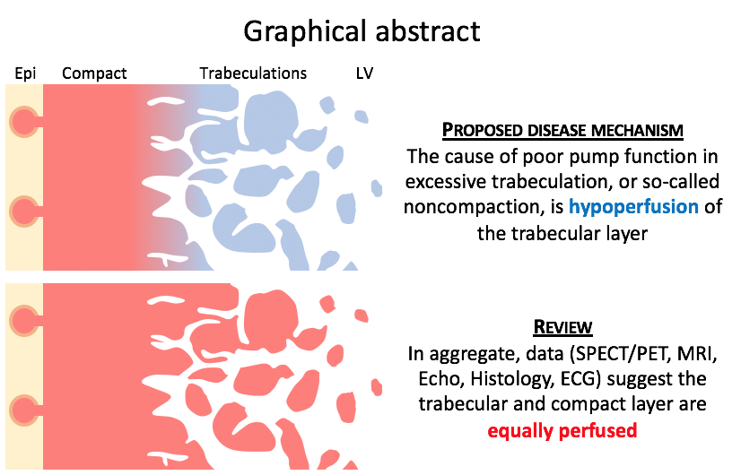 BjarkeJensen4's tweet photo. Manuscript accepted in @J_Cardiol !
Together with @_bramri_ and @s_e_petersen we review the evidence - or lack thereof? - for hypoperfusion of the trabecular layer in excessive trabeculation (aka #noncompaction) of the #heart left #ventricle
Online soon, I hope! https://t.co/wwfVHKVNEt