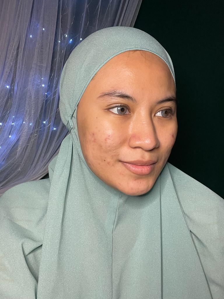 CUMA 2 MINGGU, JERAWAT BANDEL LANGSUNG MOVE ON